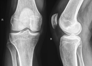 More or less normal digital radiography of a right knee in both projections